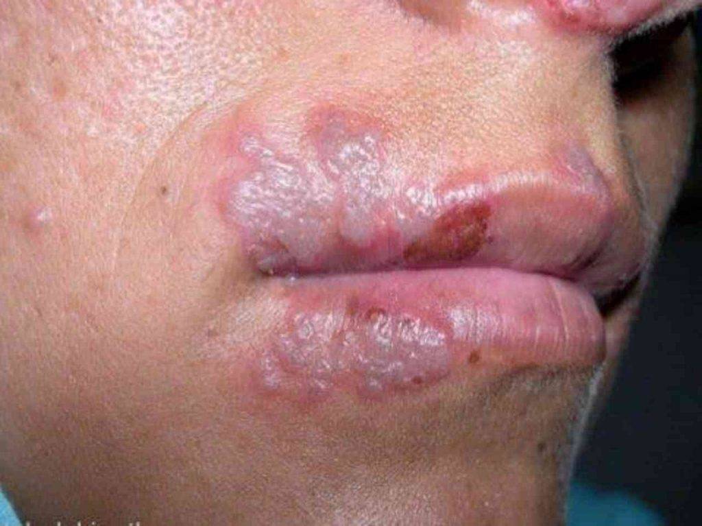 Herpes labiale