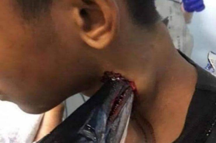 Indonesia: ragazzo infilzato al collo da un pesce, immagini shock