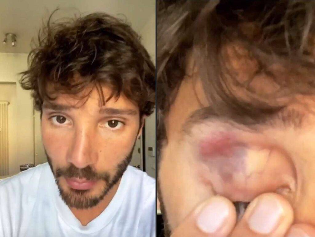 Stefano de martino occhio nero