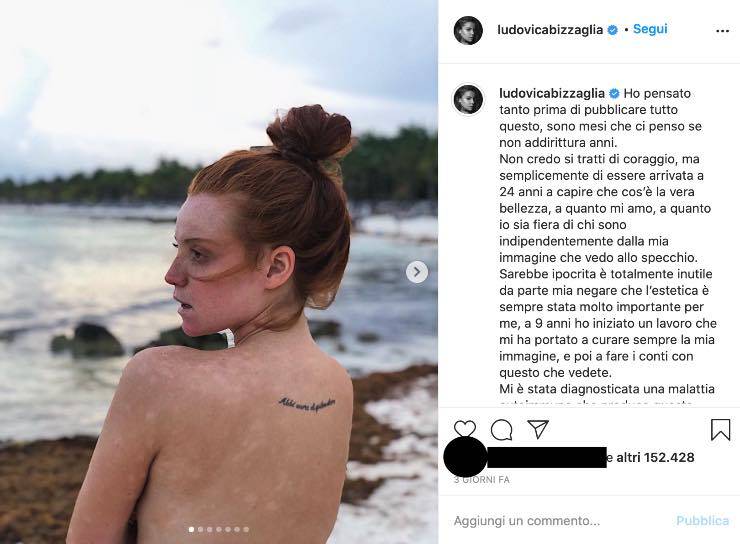 Ludovica Bizzaglia non si nasconde più e mostra i segni della malattia