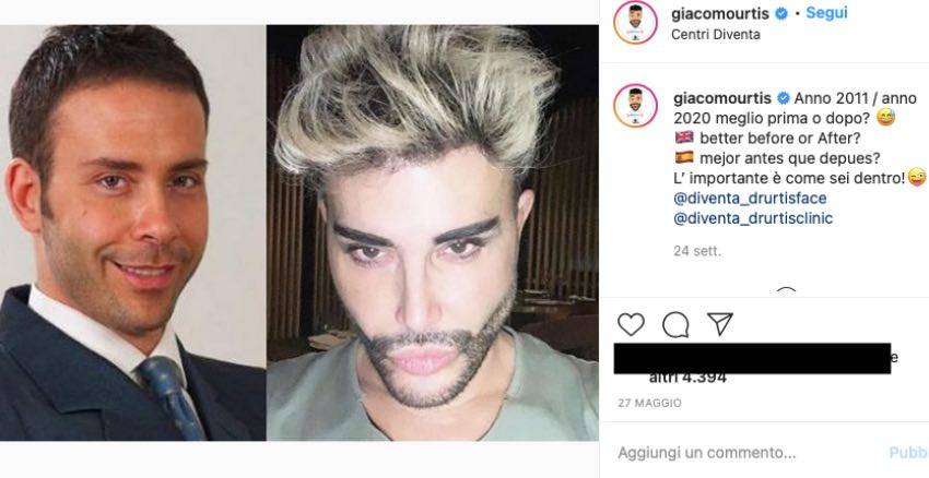 Giacomo Urtis prima e dopo: irriconoscibile, la trasformazione, FOTO