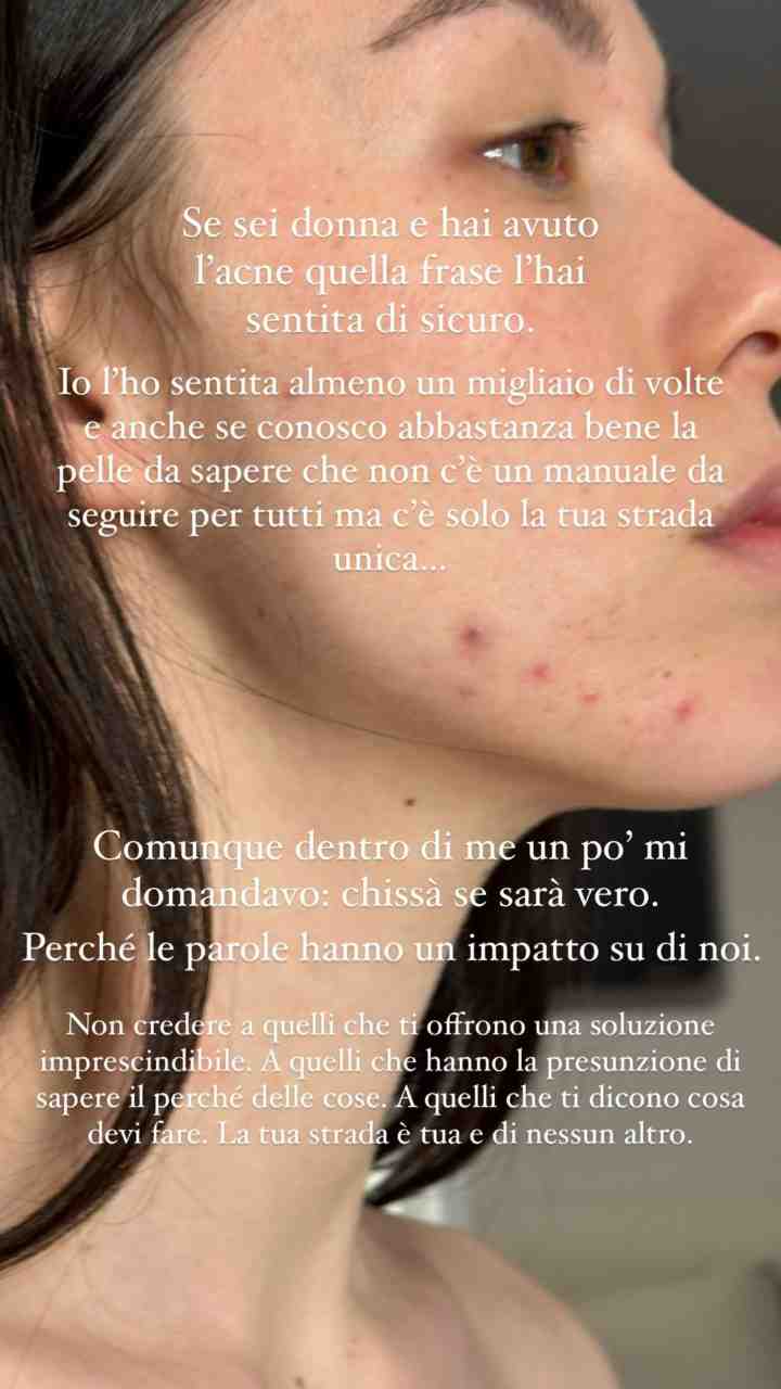 Aurora Ramazzotti, acne